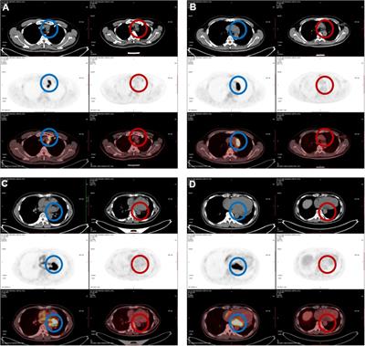 Atypical location of primary cardiac lymphoma in the left heart with atypical clinical presentation: A case report and literature review